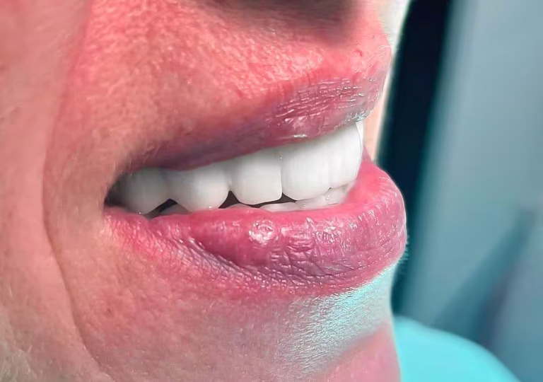 Cirkonski most na bazalnih implantatih pri pacientki – Macura Dent Banjaluka
