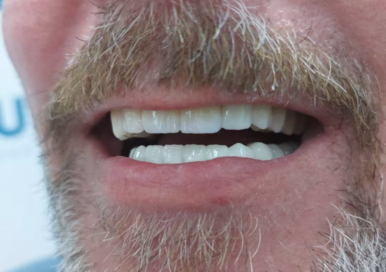 Cirkonski most na bazalnih implantatih pri pacientu – Macura Dent Banjaluka