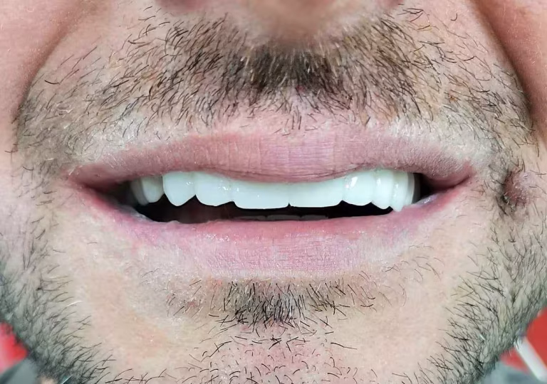Cirkonski most na implantatih pri pacientu – Macura Dent Banjaluka
