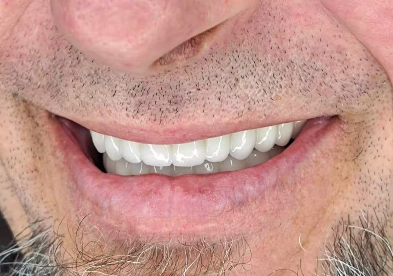 Keramični most na implantatih in naraven nasmeh pri pacientu – Macura Dent Banjaluka