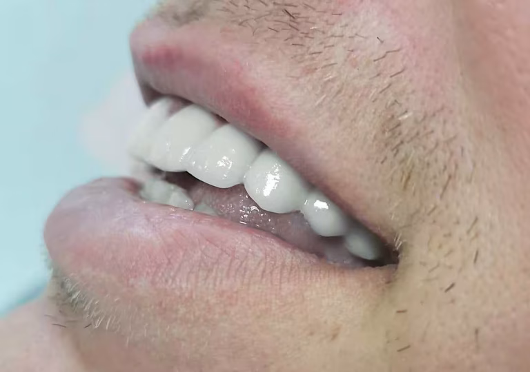 Fiksni keramični most na implantatih pri pacientu – Macura Dent Banjaluka